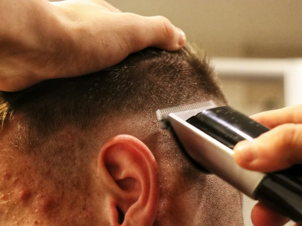 Vorbereitung des Spenderbereichs vor einer FUE-Haartransplantation – Victoria Health & Regeneration Mannheim